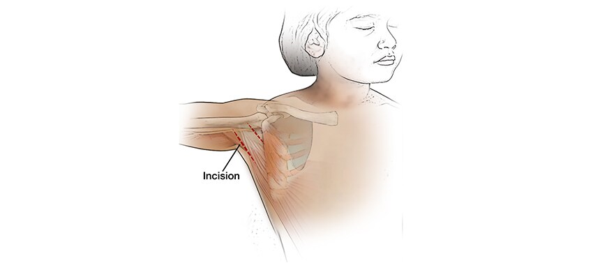 Illustration shows the incision made during a tendon transfer to repair a brachial plexus injury. 
