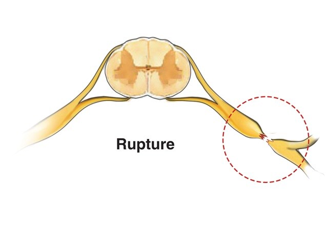 Illustration of a brachial plexus injury caused by a nerve rupture.