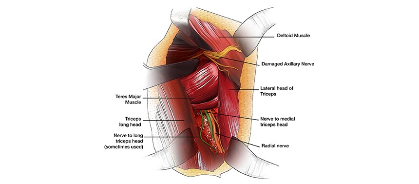 Illustration shows how the surgeon looks at the axillary nerve where damage is located.