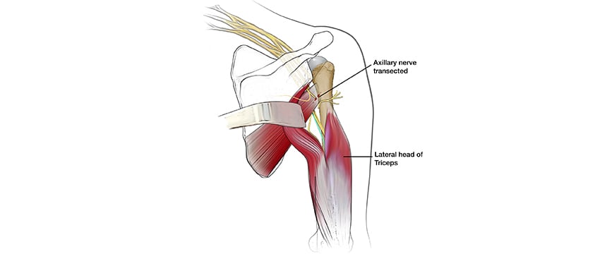 Illustration shows a damaged nerve being connected to aa healthy one during brachial plexus nerve transfer surgery.