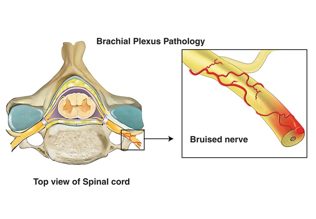 Illustration of a contusion bruise during a brachial plexus injury.