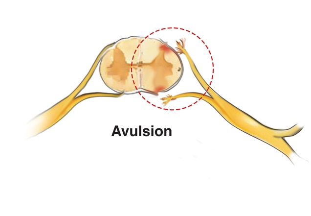 Illustration of a brachial plexus injury caused by a nerve avulsion.