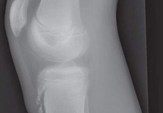X-ray image of Osgood-Schlatter disease