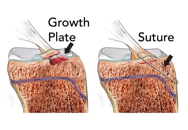 Illustration shows how the tibial spine is surgically repaired after a fracture.