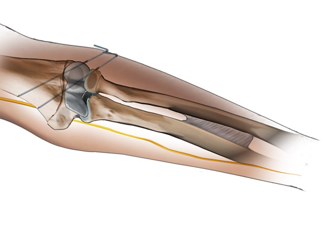 fracture repair diagram