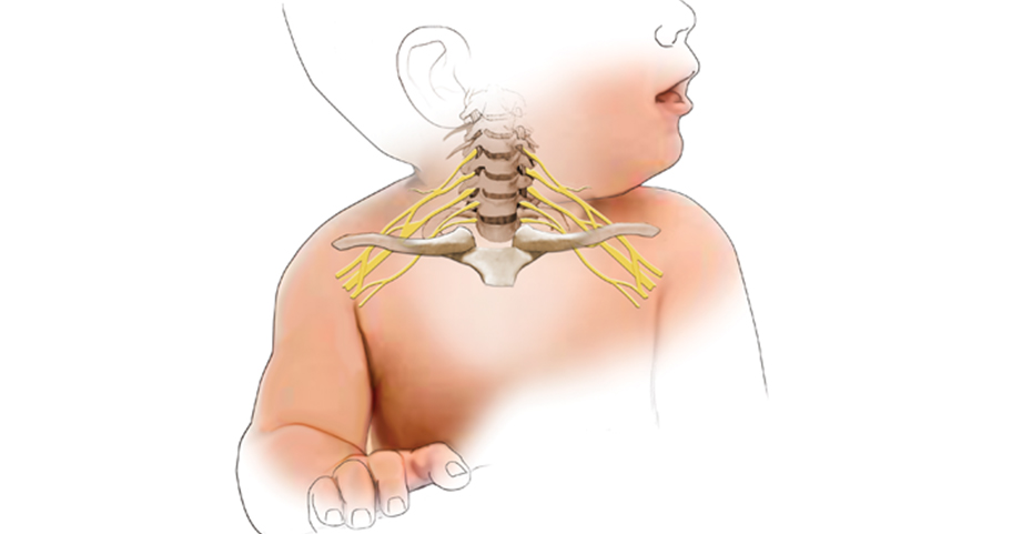 Illustration of the brachial plexus nerves in a young child.