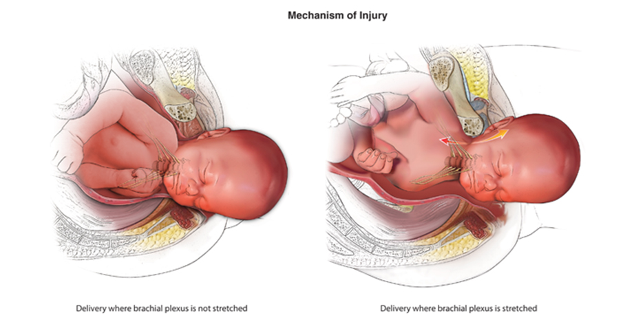 Illustration of a normal birth compared to a birth resulting in a brachial plexus injury. 