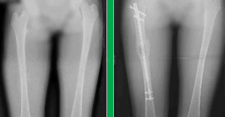 X-ray image of an internal lengthening nail procedure before and after