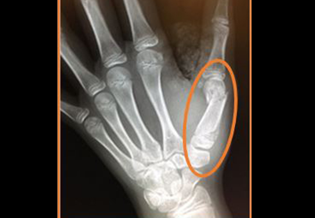 Broken thumb x ray