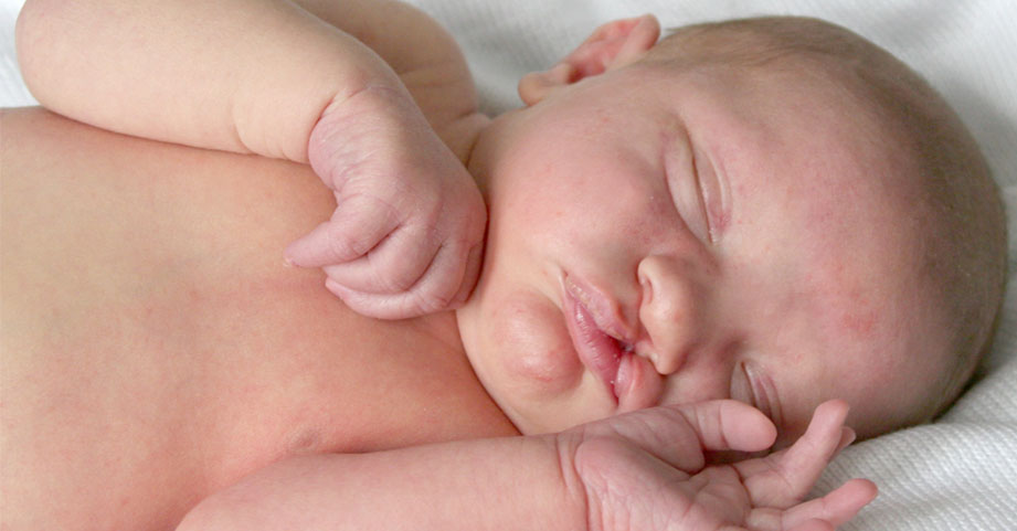 A newborn with a cleft lip.