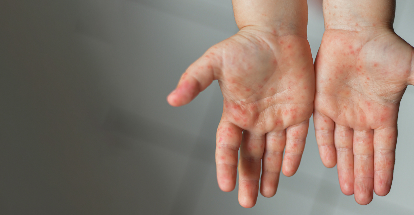Measles rash on a child's hands