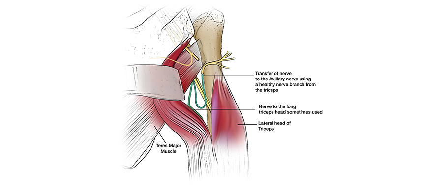 Illustration shows a healthy nerve from the bicep being transferred to the axillary nerve during a nerve transfer surgery for a brachial plexus injury.