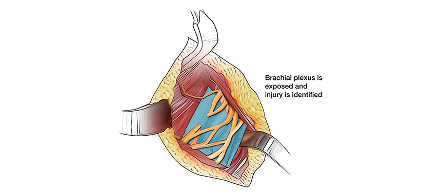 Illustration showing the brachial plexus injury during surgery.