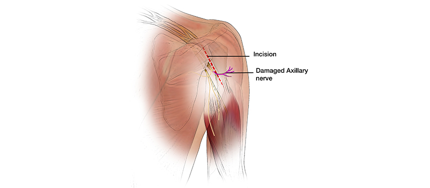Illustration shows the incision on the back of the shoulder to perform a nerve transfer to repair a brachial plexus injury