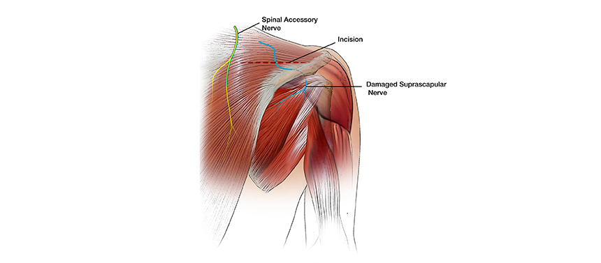 Illustration shows the incision made over the shoulder blade during a surgery to restore shoulder abduction for a brachial plexus injury.