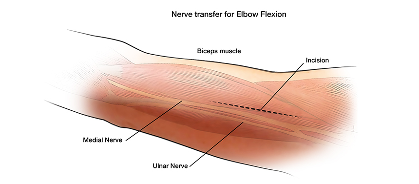 Illustration shows the incision made on the upper arm during surgery to restor elbow movement for a brachial plexus injury.