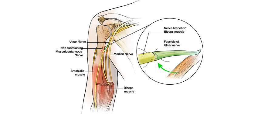 Illustration shows the healthy ulnar nerve used to repair the damaged nerve to restore elbow movement for a brachial plexus injury.