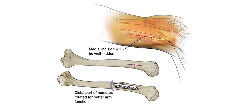 Illustration shows the plate and screws used to keep the bones in place after a humeral osteotomy to repair a brachial plexus injury.
