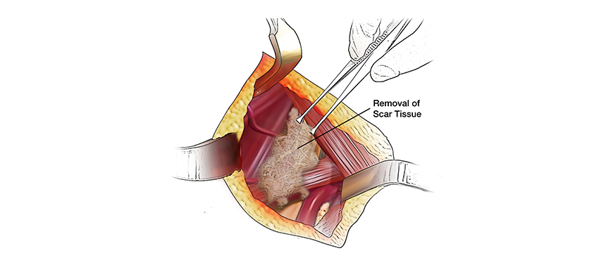 Illustration of scar tissue removal during nerve graft surgery for brachial plexus injury.
