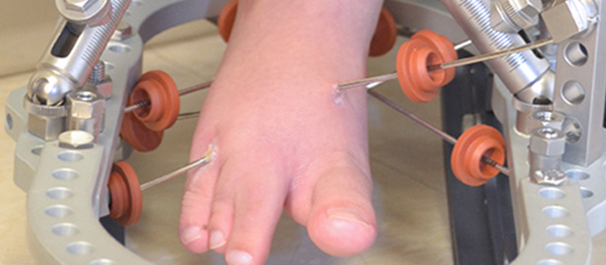foot external fixator pins