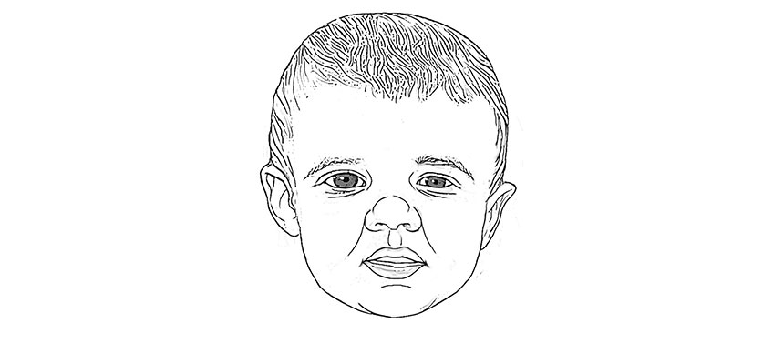 Sketch of child with one eye appearing smaller than the other
