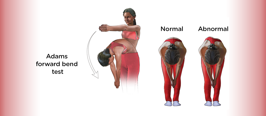 forward bend scoliosis stretch graphic