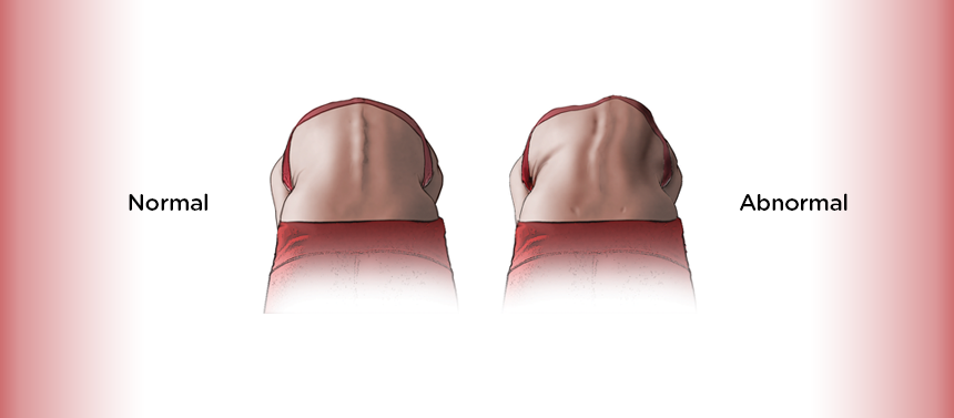 posterior back bend scoliosis screening graphic